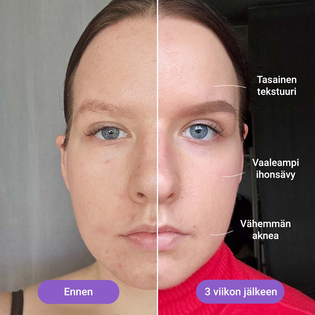 IPL-valoepilaattori “Hilda” + Valohoitonaamio kasvoille 