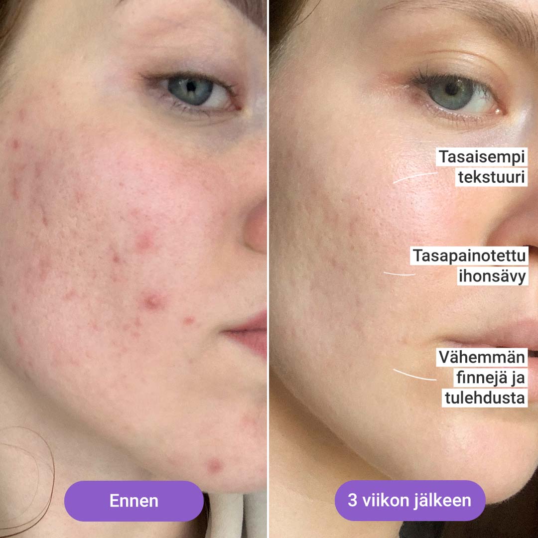 IPL-valoepilaattori “Hilda” + Valohoitonaamio kasvoille 
